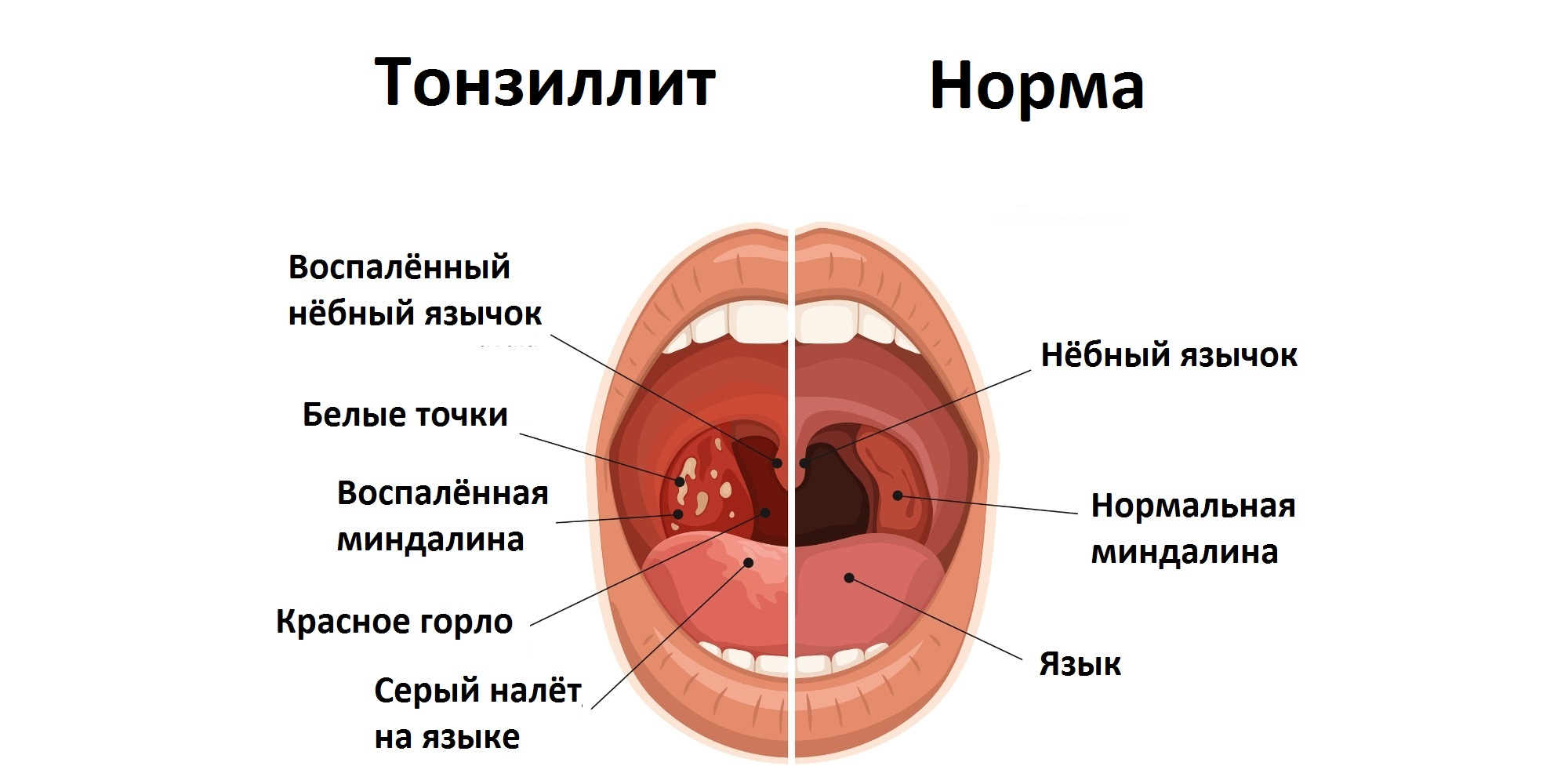 Хронический тонзиллит и нормальное состояние полости рта