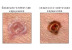 Рак кожи – карцинома